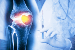 Ứng dụng tế bào gốc trong điều trị thoái hóa khớp