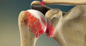 Ứng dụng tế bào gốc trong phục hồi xương, khớp và mô tổn thương